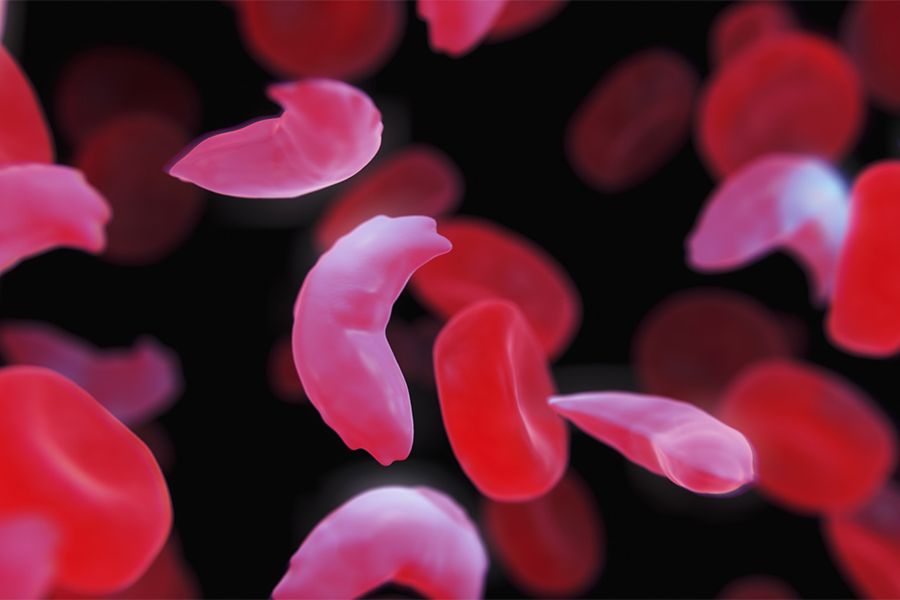 Sickle cell blood image